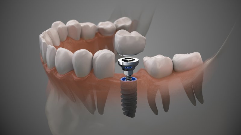 how long does it take dental implants to heal