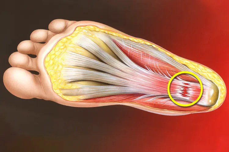 plantar fasciitis